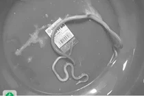 Người đàn ông 77 tuổi bị tắc ruột do giun