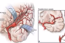 Phẫu thuật phức tạp cứu bệnh nhân phình mạch não lớn, cách gì phát hiện sớm?