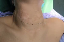 Cổ chẳng chịt sẹo ... vì đắp lá, uống thuốc nam