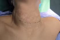 Cổ chẳng chịt sẹo ... vì đắp lá, uống thuốc nam