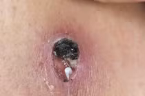 Giun rồng 1 mét chui ra từ người đàn ông 44 tuổi, cách phòng bệnh