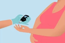 Hiếm gặp: đái tháo tháo type 1 thể tối cấp ở thai phụ