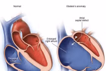 17 tuổi phát hiện tim giống cánh buồm