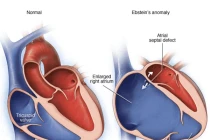 17 tuổi phát hiện tim giống cánh buồm
