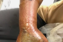 Hoại tử nghiêm trọng bàn tay vì đắp thuốc nam khi bị rắn hổ mang cắn