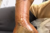 Hoại tử nghiêm trọng bàn tay vì đắp thuốc nam khi bị rắn hổ mang cắn