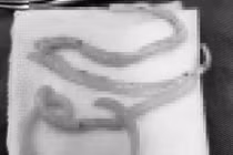 Người phụ nữ bị giun đũa đâm thủng ruột non, cách gì phòng tránh