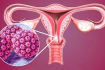 Virus HPV gây ung thư nhưng liệu chúng ta có thể ngăn ngừa?