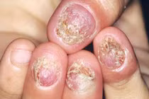 Cẩn thận bệnh nấm da trời nồm