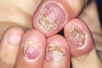 Cẩn thận bệnh nấm da trời nồm