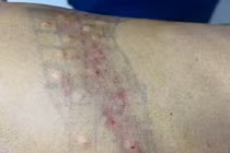 Tiêm Botulinum toxin - Giải pháp mới trong điều trị đau sau zona