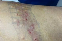 Tiêm Botulinum toxin - Giải pháp mới trong điều trị đau sau zona