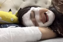 Cô gái "bốc cháy" do nổ bóng bay sinh nhật: Xử lý bỏng sao cho đúng?