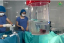 Bé gái 14 tuổi mắc đa polyp buồng tử cung