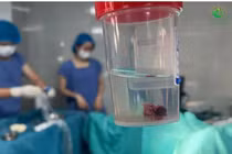 Bé gái 14 tuổi mắc đa polyp buồng tử cung