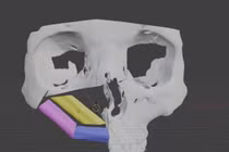 Công nghệ in 3D điều trị ung thư xương hàm mặt