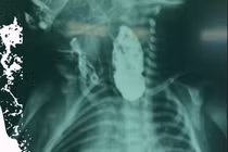  Nội soi tiên tiến cứu sống bé sơ sinh nặng 2,6 kg teo thực quản