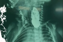  Nội soi tiên tiến cứu sống bé sơ sinh nặng 2,6 kg teo thực quản