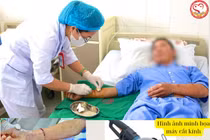 Cơn ác mộng của người đàn ông 2 lần bị lưỡi cưa cắt "đứt" tay