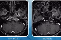 Cụ bà 90 tuổi vượt qua ung thư vòm họng nhờ xạ trị hiện đại