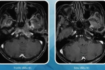 Cụ bà 90 tuổi vượt qua ung thư vòm họng nhờ xạ trị hiện đại