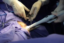 Phẫu thuật Starr giải quyết nỗi ám ảnh đại tiện khó, táo bón kéo dài