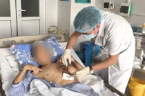 Mắc nấm hiếm gặp, người đàn ông bị hoại tử vùng ngực phải mổ 3 lần