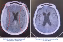 Ngã xuống nền cứng, sau nhiều ngày mới phát hiện máu tụ trong não