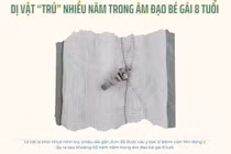 Hy hữu: Dị vật “trú” nhiều năm trong âm đạo bé gái 8 tuổi