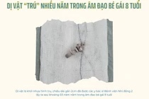 Hy hữu: Dị vật “trú” nhiều năm trong âm đạo bé gái 8 tuổi