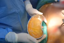 Hy hữu: Đang mang thai lần 3, người phụ nữ bị vỡ túi nâng ngực