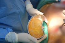 Hy hữu: Đang mang thai lần 3, người phụ nữ bị vỡ túi nâng ngực