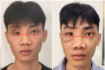 Tạo hình thành ổ mắt bằng công nghệ titan chữa mắt biến dạng sau tai nạn