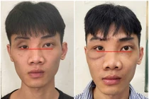 Tạo hình thành ổ mắt bằng công nghệ titan chữa mắt biến dạng sau tai nạn