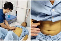 Ăn nấm tự nhiên, nhiều người ngộ độc, suy gan thận nặng