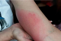 Đầu hè nhiều người đã bị sốc phản vệ do ong đốt, xử lý thế nào?