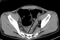 hủng ruột vì hội chứng thích ăn đồ vật
