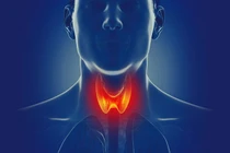 Cơn bão giáp trạng là gì mà tỷ lệ tử vong gần 100%