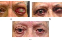 Biến chứng mắt nặng do bệnh Basedow