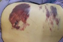 Tự dùng thuốc tại nhà người bệnh bầm tím, chảy dịch lưng... dễ nguy kịch