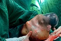 Em bé đầu năm sinh bọc điều với tỷ lệ hy hữu 1/80.000 ca