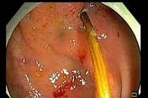 Hy hữu: Chiếc tăm xuyên thủng đại tràng cụ ông 71 tuổi chỉ vì thói quen