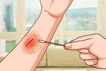 Cách chăm sóc vết thương tại nhà để tránh hoại tử 