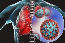 Virus HMPV gây viêm phổi đang lây lan ở Trung Quốc nguy hiểm thế nào?