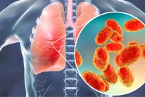  Virus Mycoplasma gây viêm phổi - Ảnh minh họa