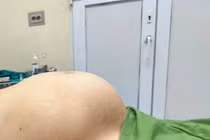 Người phụ nữ 65 tuổi mang khối u “khủng” như mang thai 8 tháng