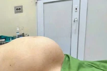 Người phụ nữ 65 tuổi mang khối u “khủng” như mang thai 8 tháng