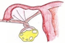 Bé 13 tuổi bị xoắn 7 vòng vòi buồng trứng phải