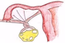 Bé 13 tuổi bị xoắn 7 vòng vòi buồng trứng phải