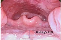 Trẻ 9 tuổi bị u lưỡi không ngờ lạc sản niêm mạc dạ dày hiếm gặp